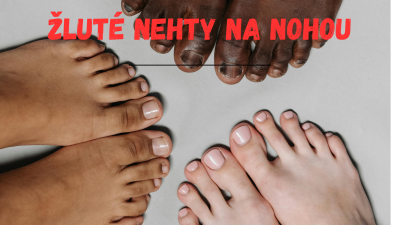 Žlté nechty na nohách: Ako im vrátiť zdravý vzhľad? | ARNO-obuv.sk - obuv s tradíciou